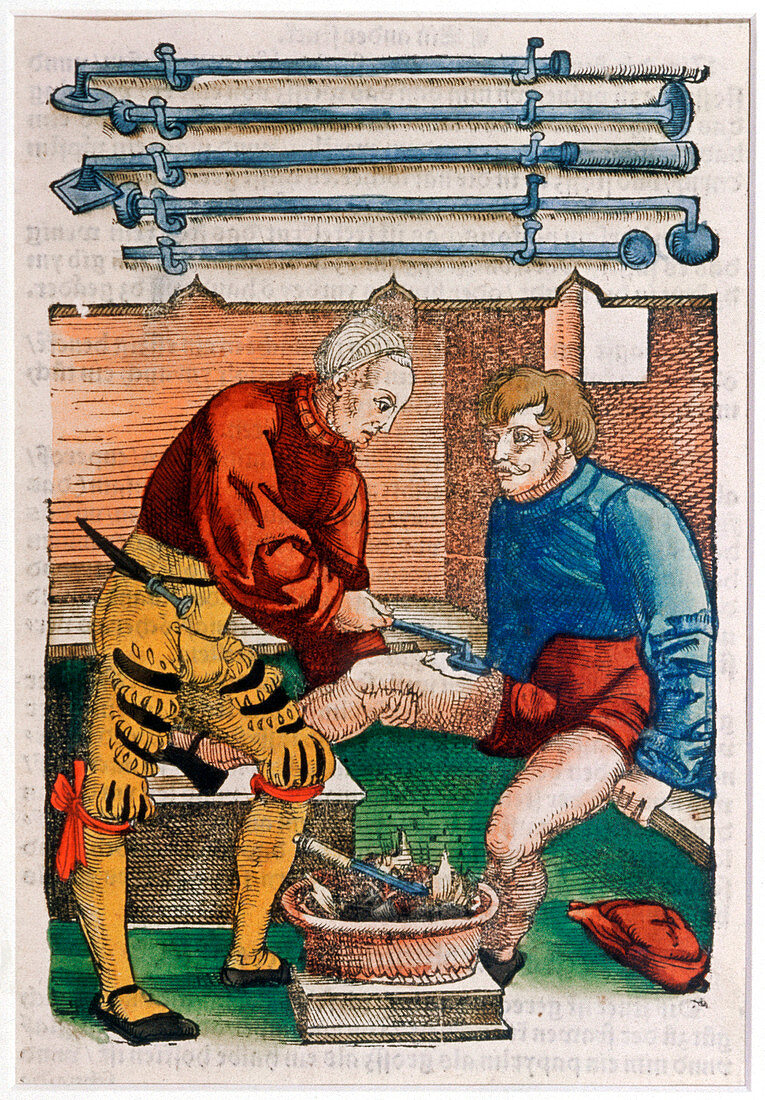 Wound cauterisation,16th century