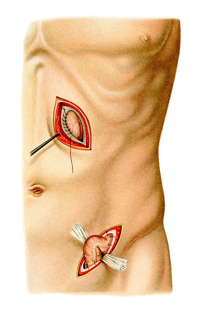 Stomach and colon surgery,artwork