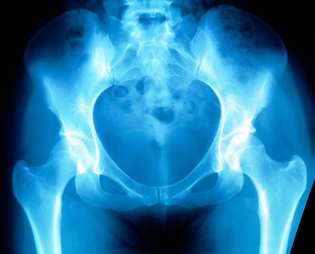 False-colour X-ray of a normal adult female pelvis