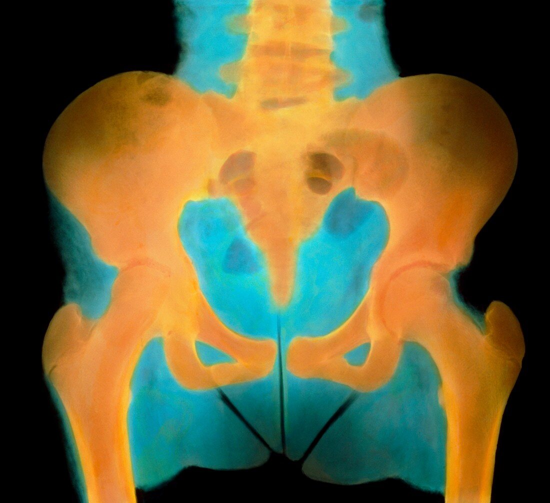 Coloured X-ray of the pelvis of a 13-year-old girl