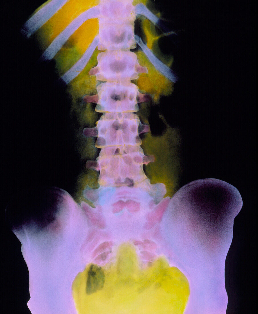 Coloured X-ray of normal spine,T-10 to pelvis