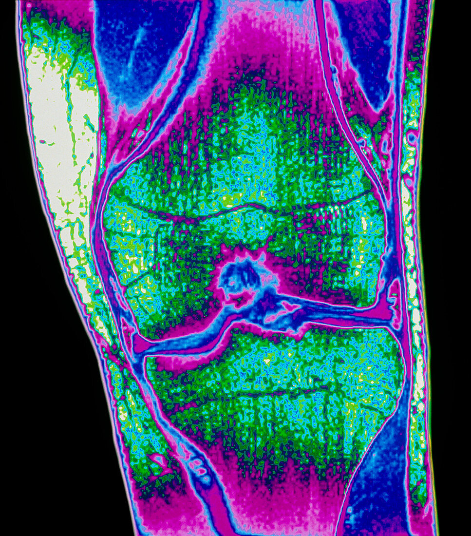 Coloured MRI of a section through a knee joint