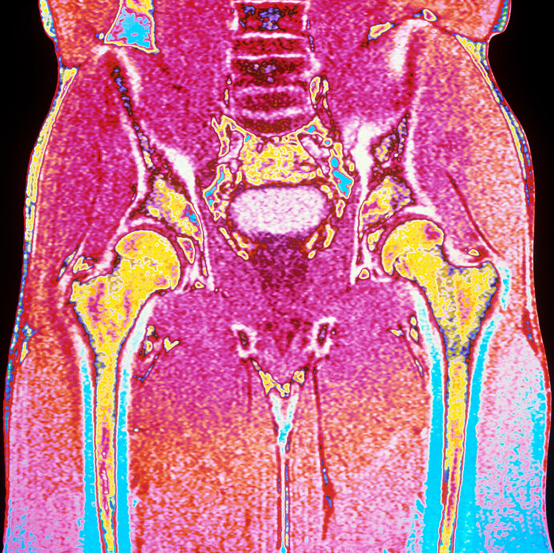 Coloured MRI scan of section through a man's hips