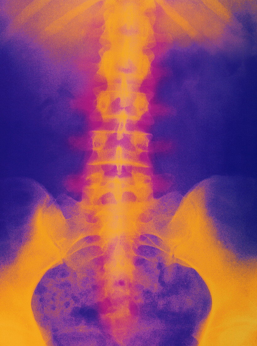 Coloured X-ray of normal lower spine and pelvis