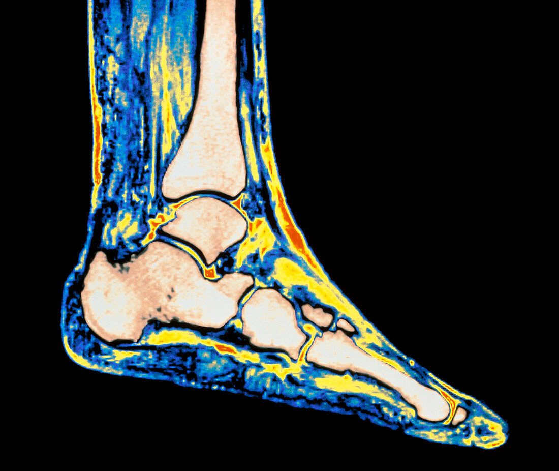 Coloured MRI scan of ankle bones in the human foot