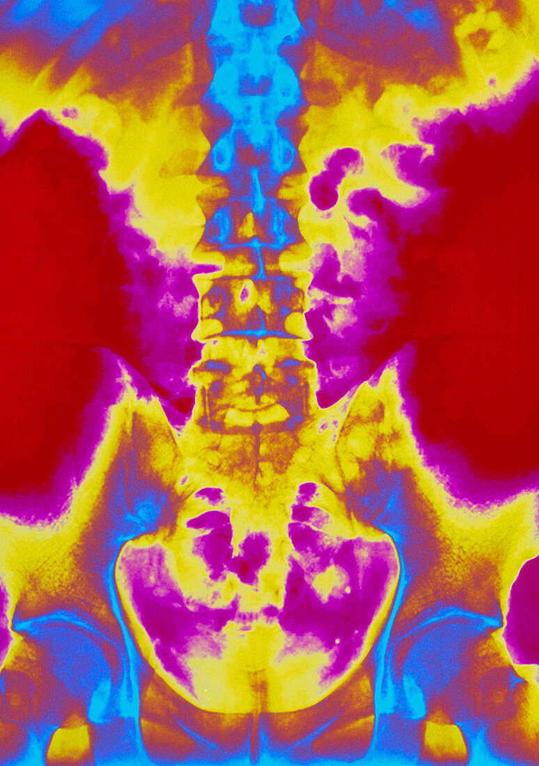 Coloured X-ray of normal lumbar spine (lower back)