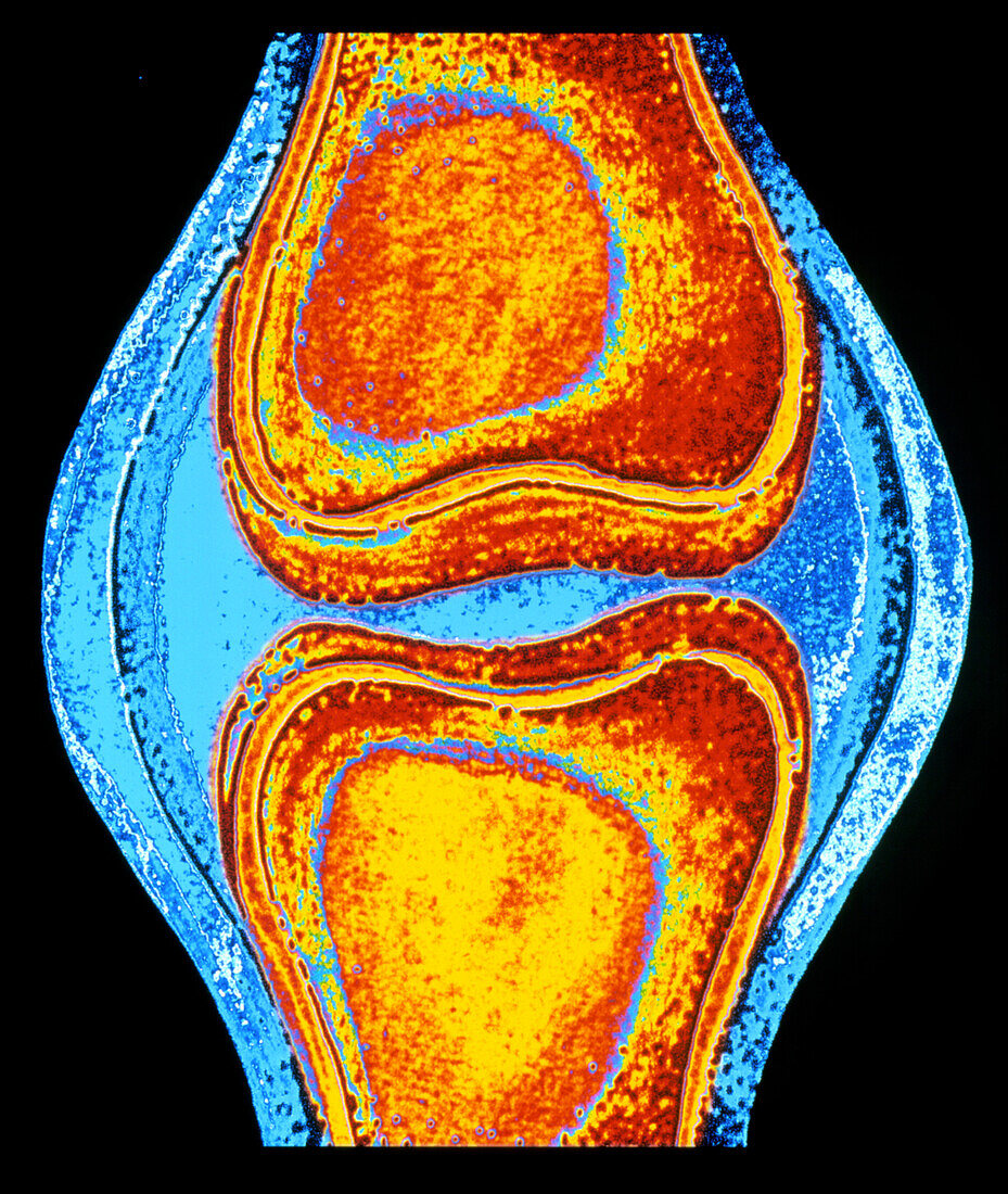 Computer artwork of a human knee joint