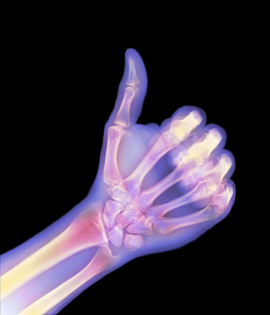 Coloured X-ray of a hand giving a thumb-u