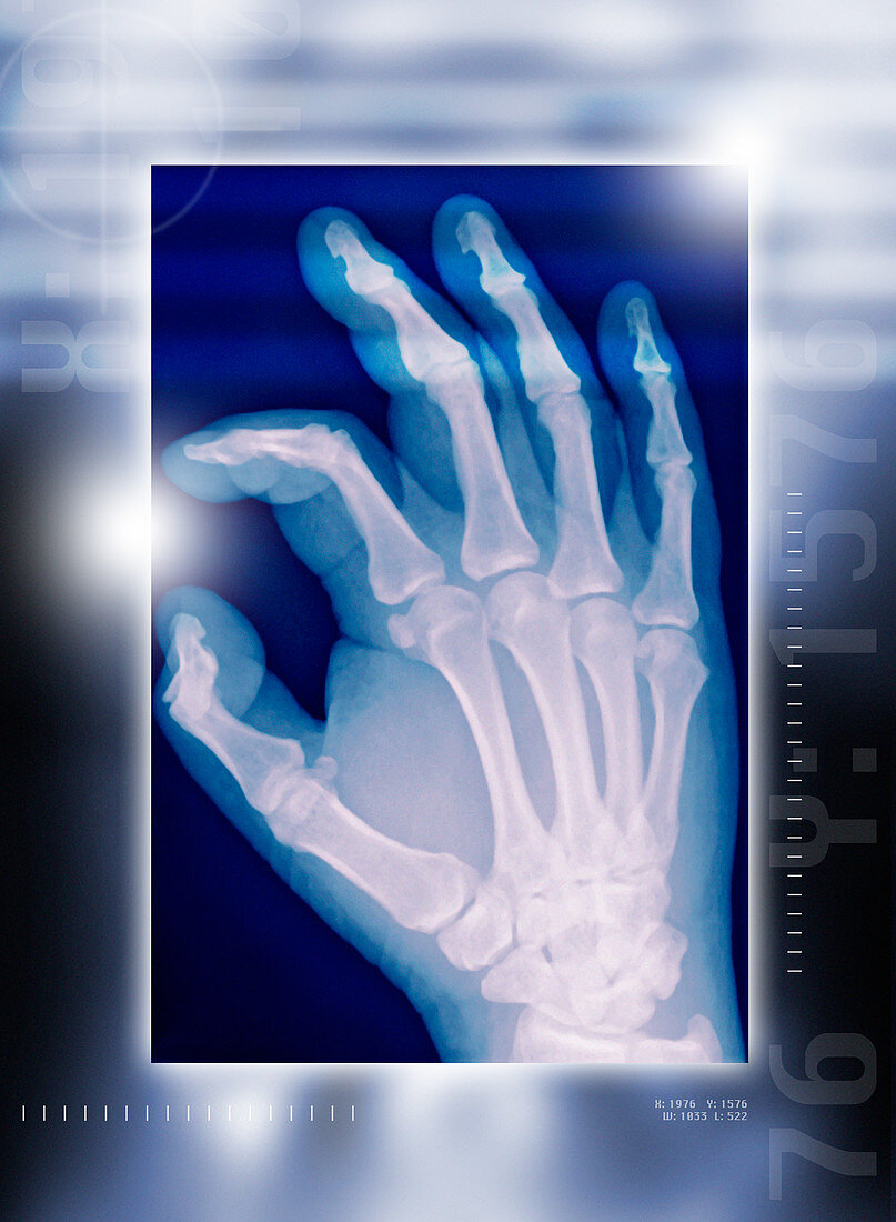 Healthy hand,X-ray