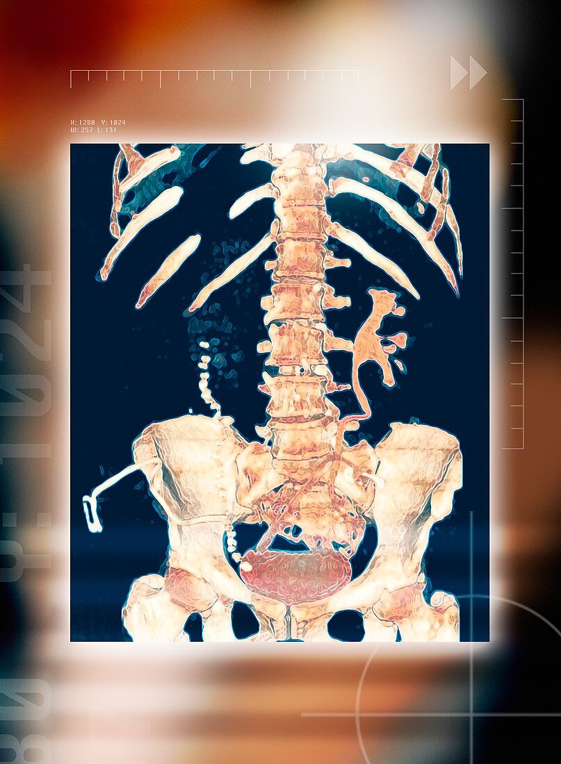 Abdominal bones,3-D CT scan