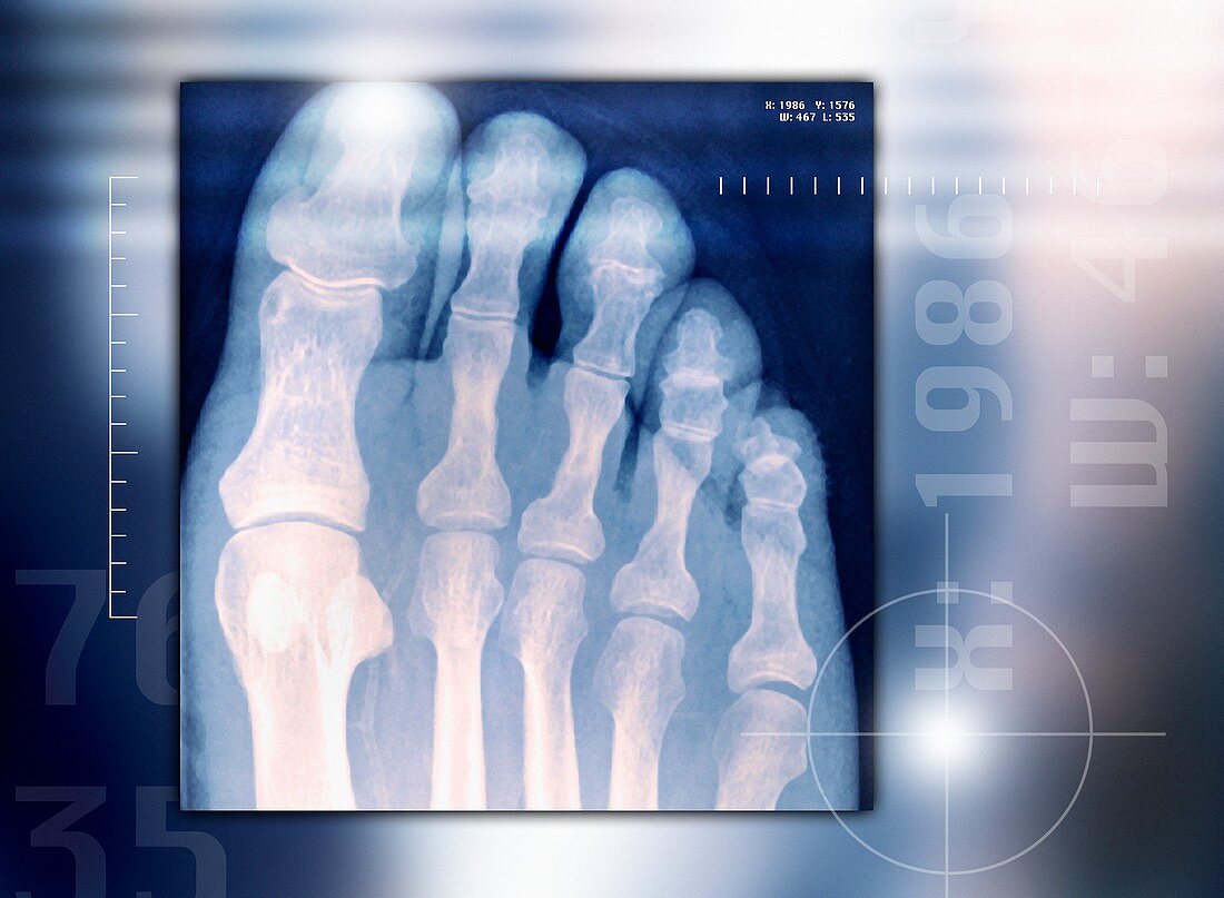 Toes,X-ray