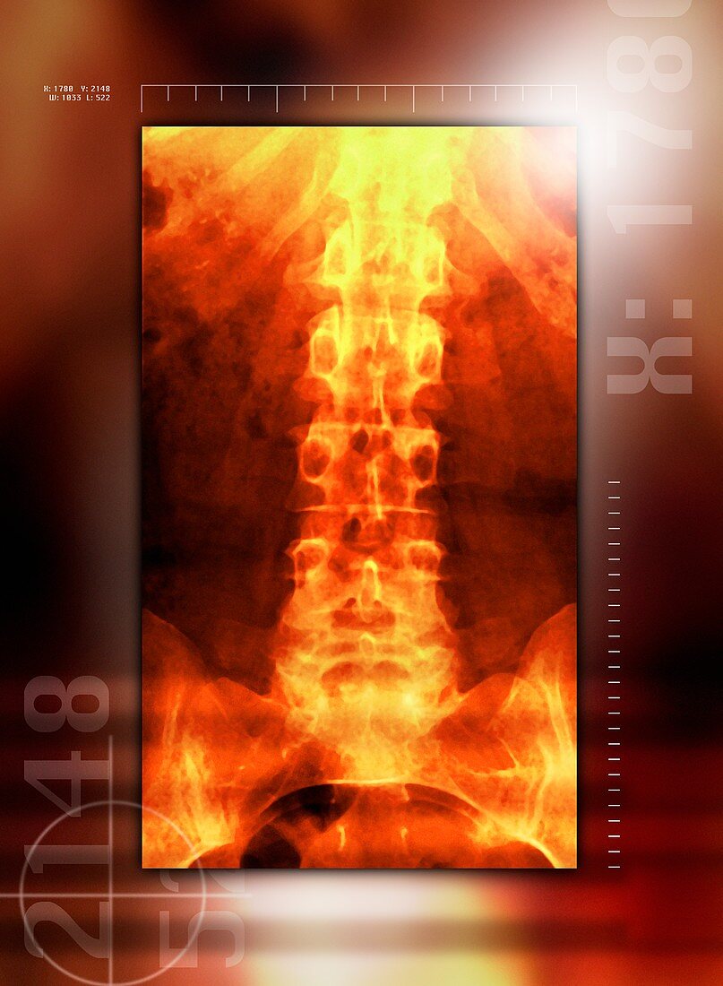 Healthy lower back,X-ray