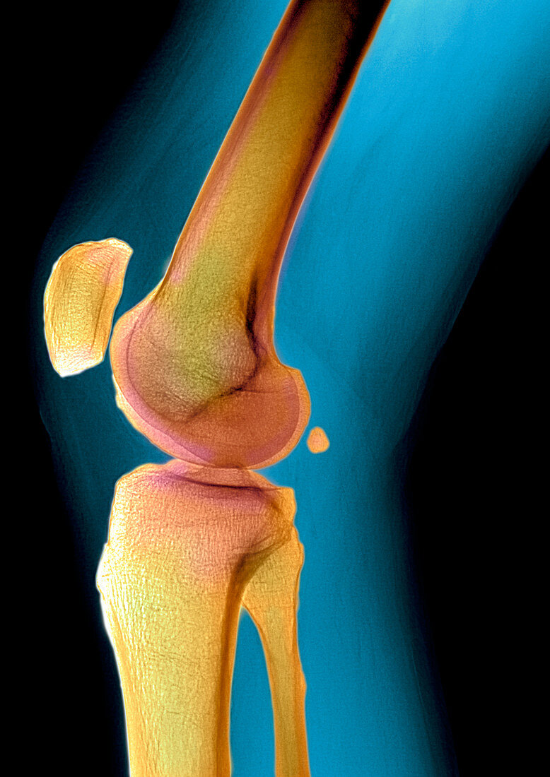 Healthy knee,X-ray