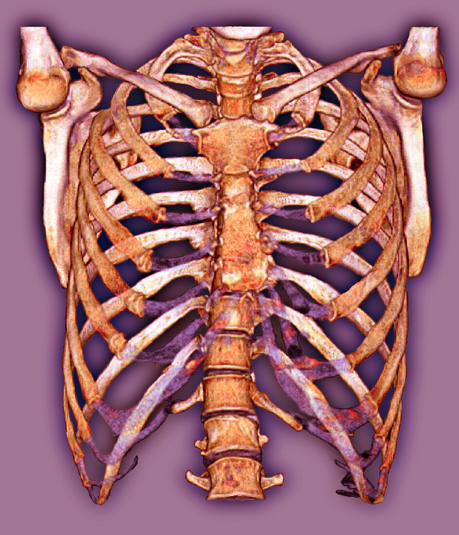 Rib cage,3D CT scan