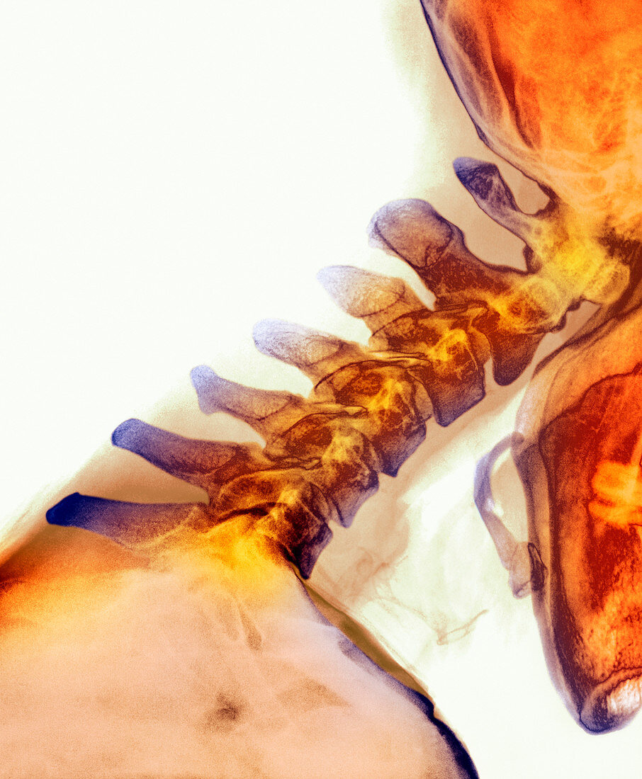 Neck vertebrae extended,X-ray