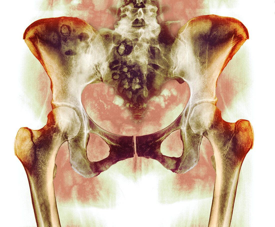 Healthy hip bones,X-ray