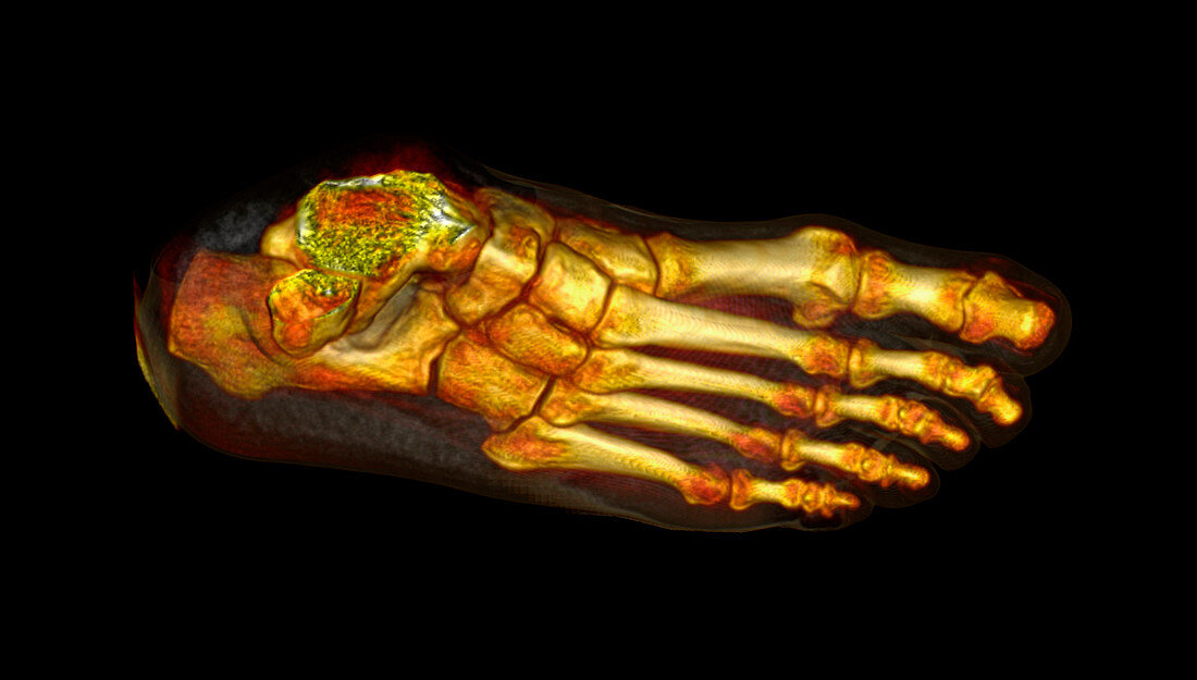 Foot,CT scan