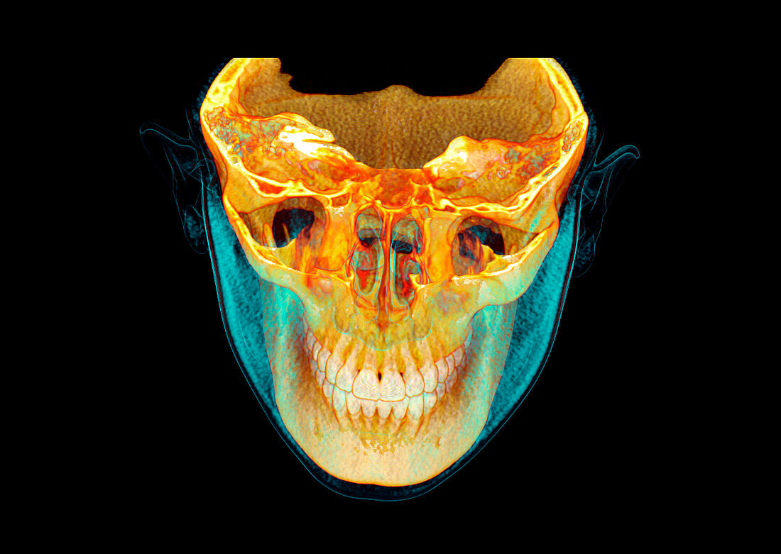 Jaw bones,CT scan