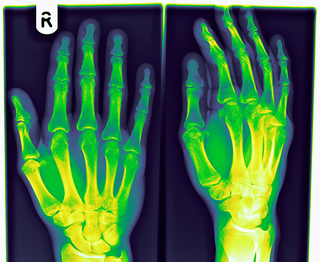 Hand,X-ray