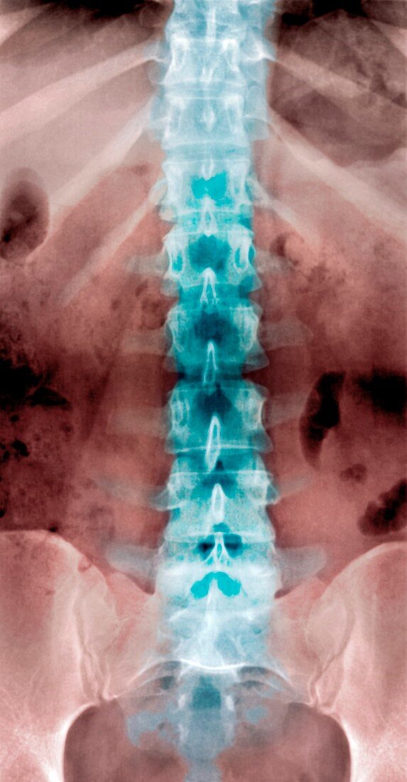 Normal lumbar spine,X-ray