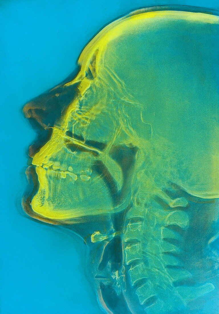 Human skull,X-ray