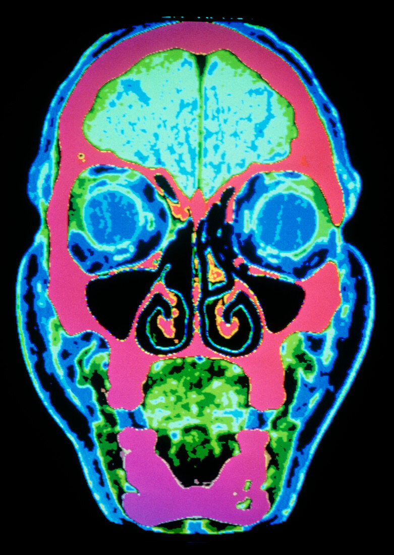 Coloured CT scan of a normal skull