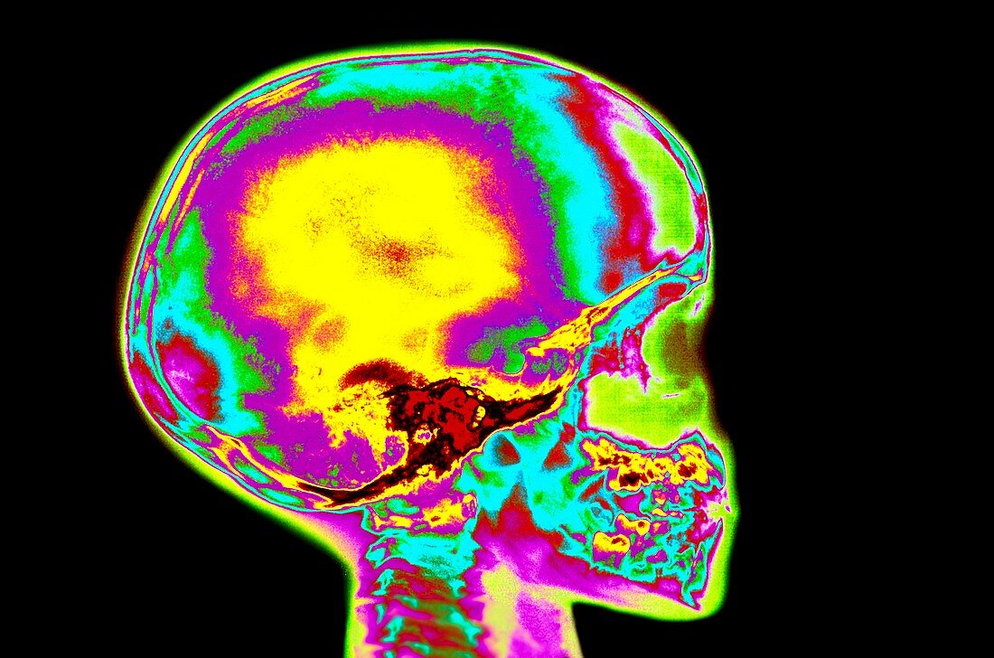 Coloured X-ray of child's skull and tooth eruption