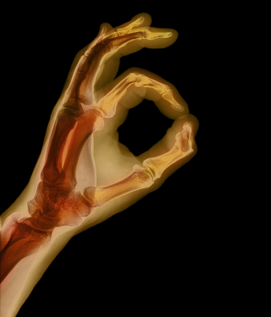 X-ray showing okay sign