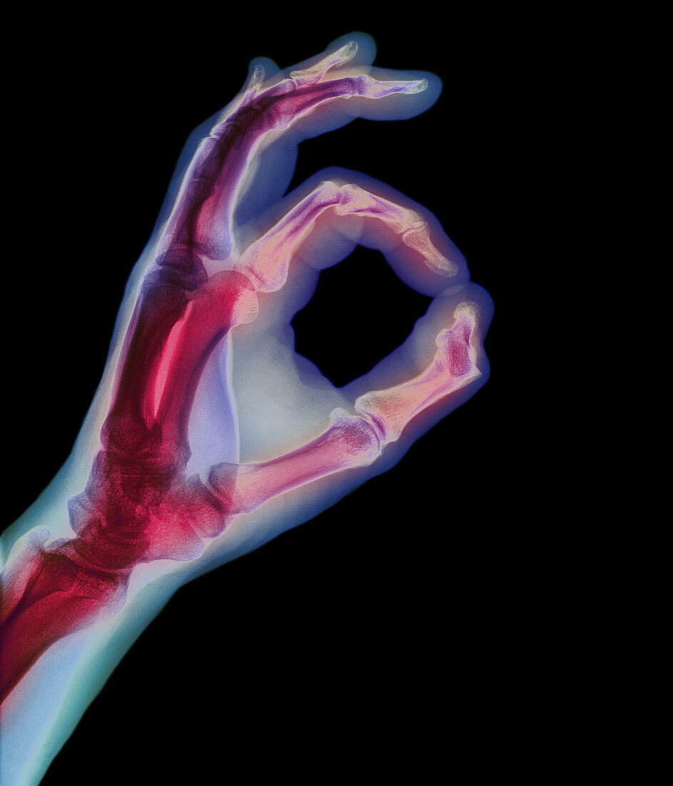 X-ray showing oksy sign