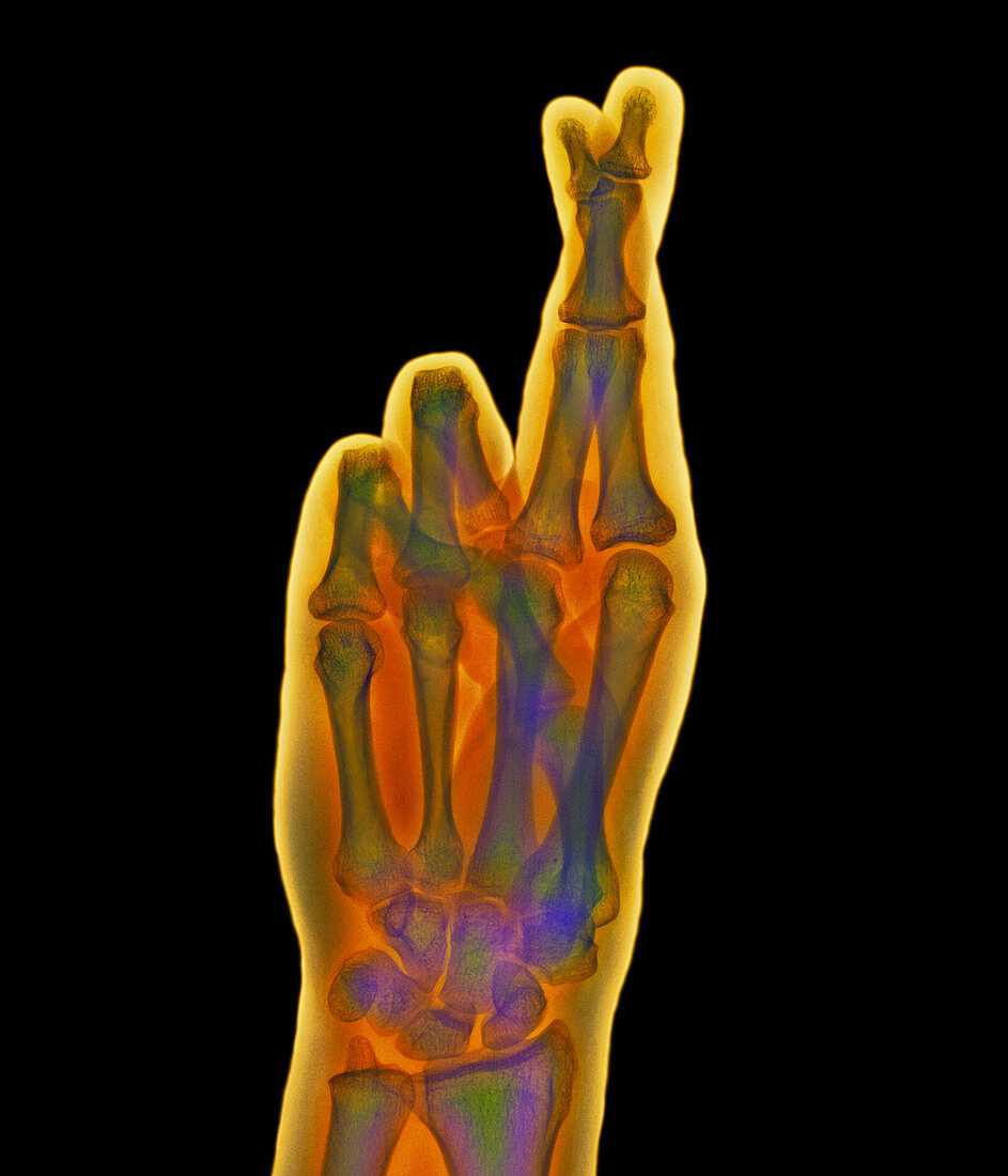 Coloured X-ray of a hand with crossed fingers