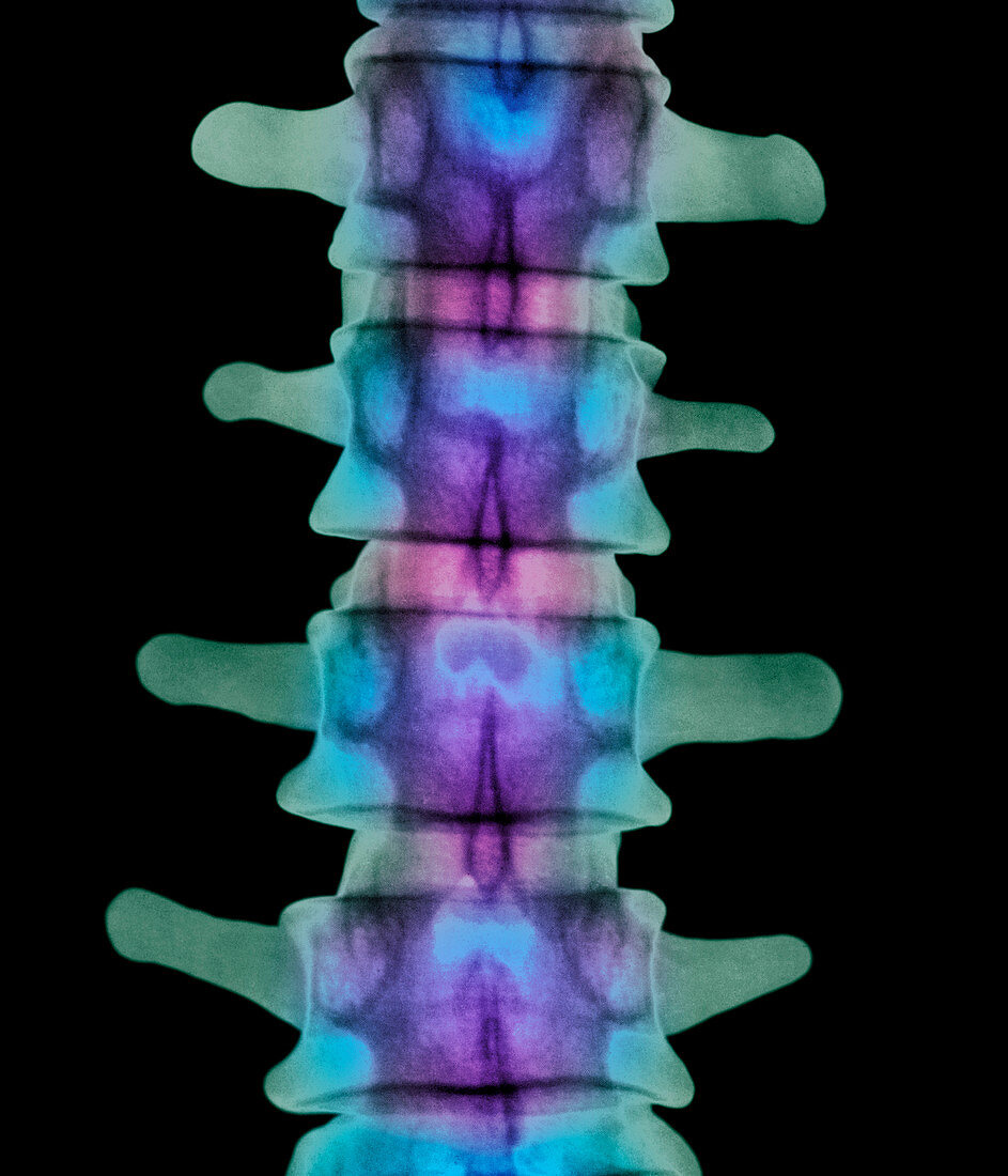 Coloured X-ray of lumbar vertebrae of the spine