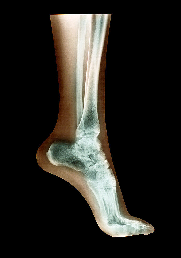 Coloured X-ray of the bones in the foot