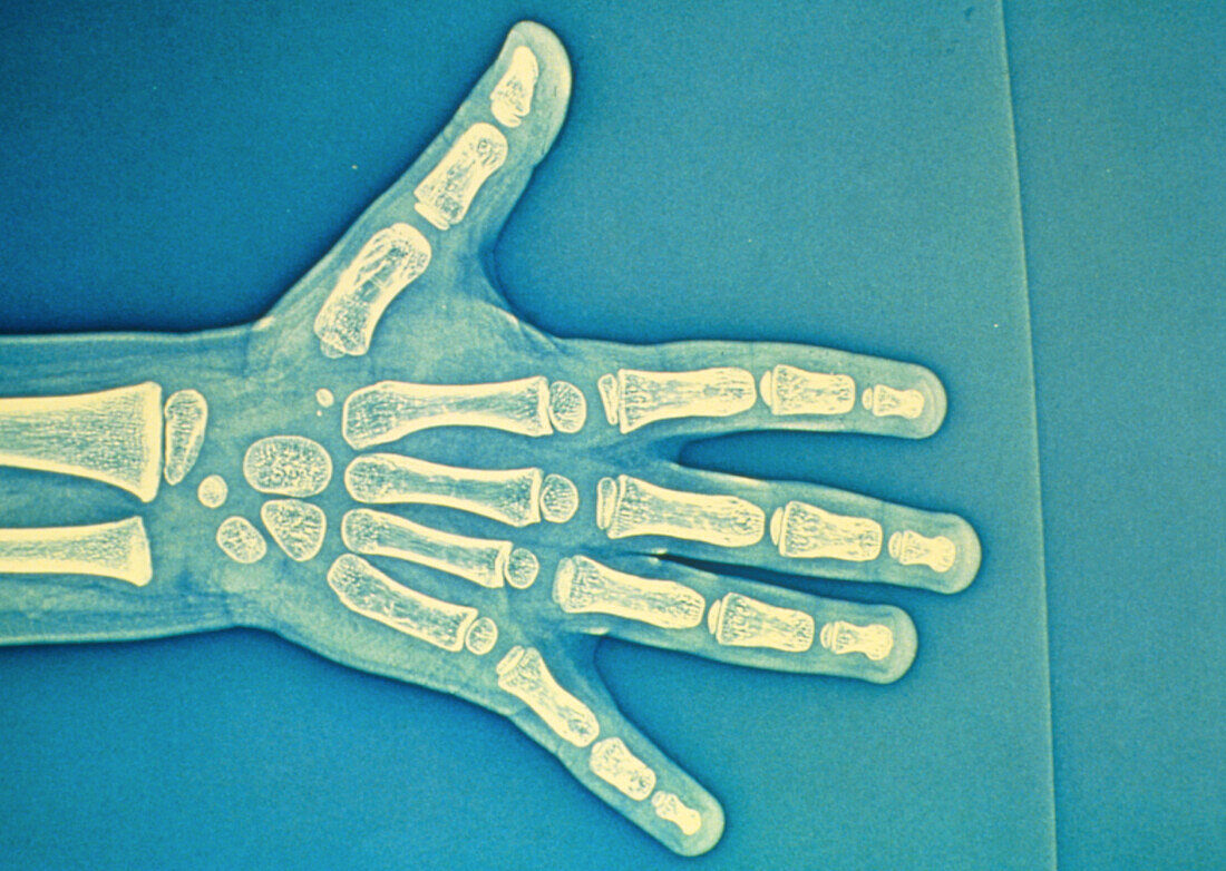 Child hand X-ray