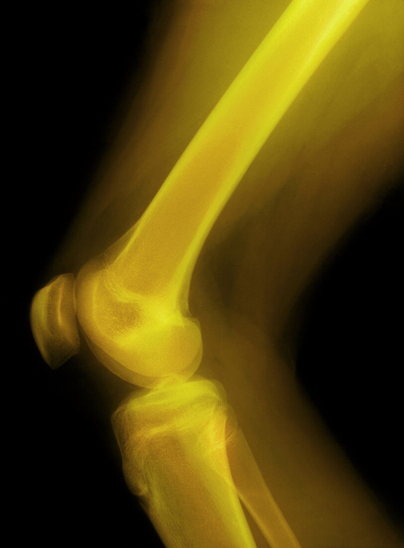 Knee joint,X-ray