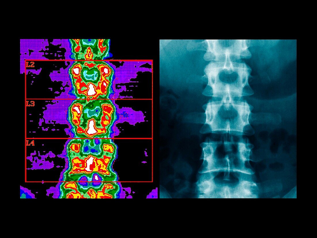 Lower spine,bone density scan