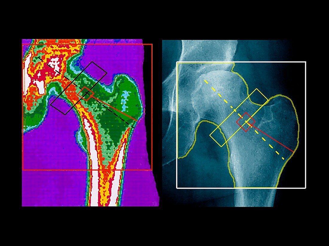 Hip,bone density scan