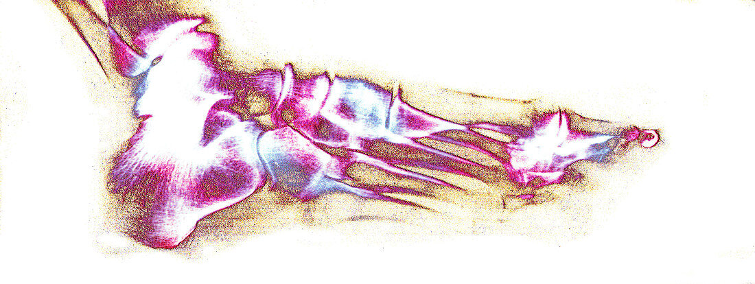 Foot bones,X-ray