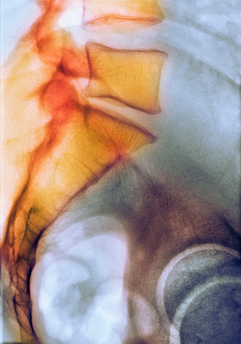 Coccyx and lower back,X-ray