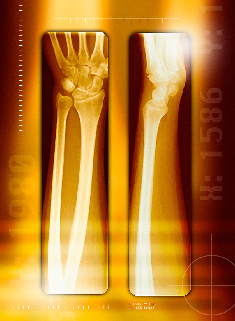 Healthy forearm,X-rays