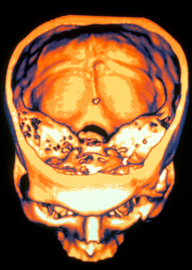 3-D CT scan of human skull