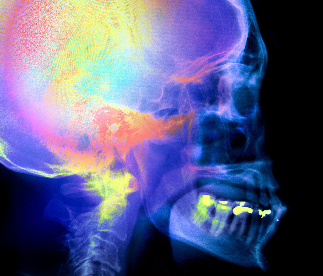 Coloured X-ray of a human skull seen from the side