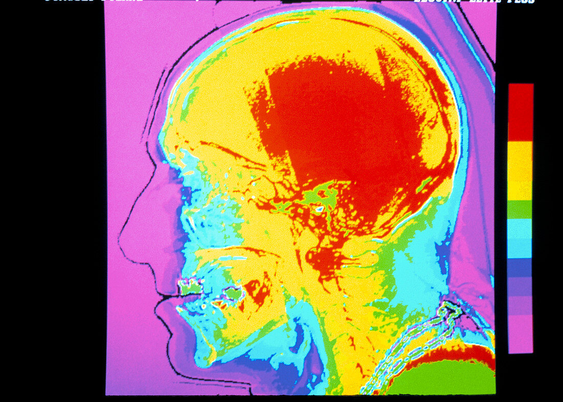 Human skull,CT scan