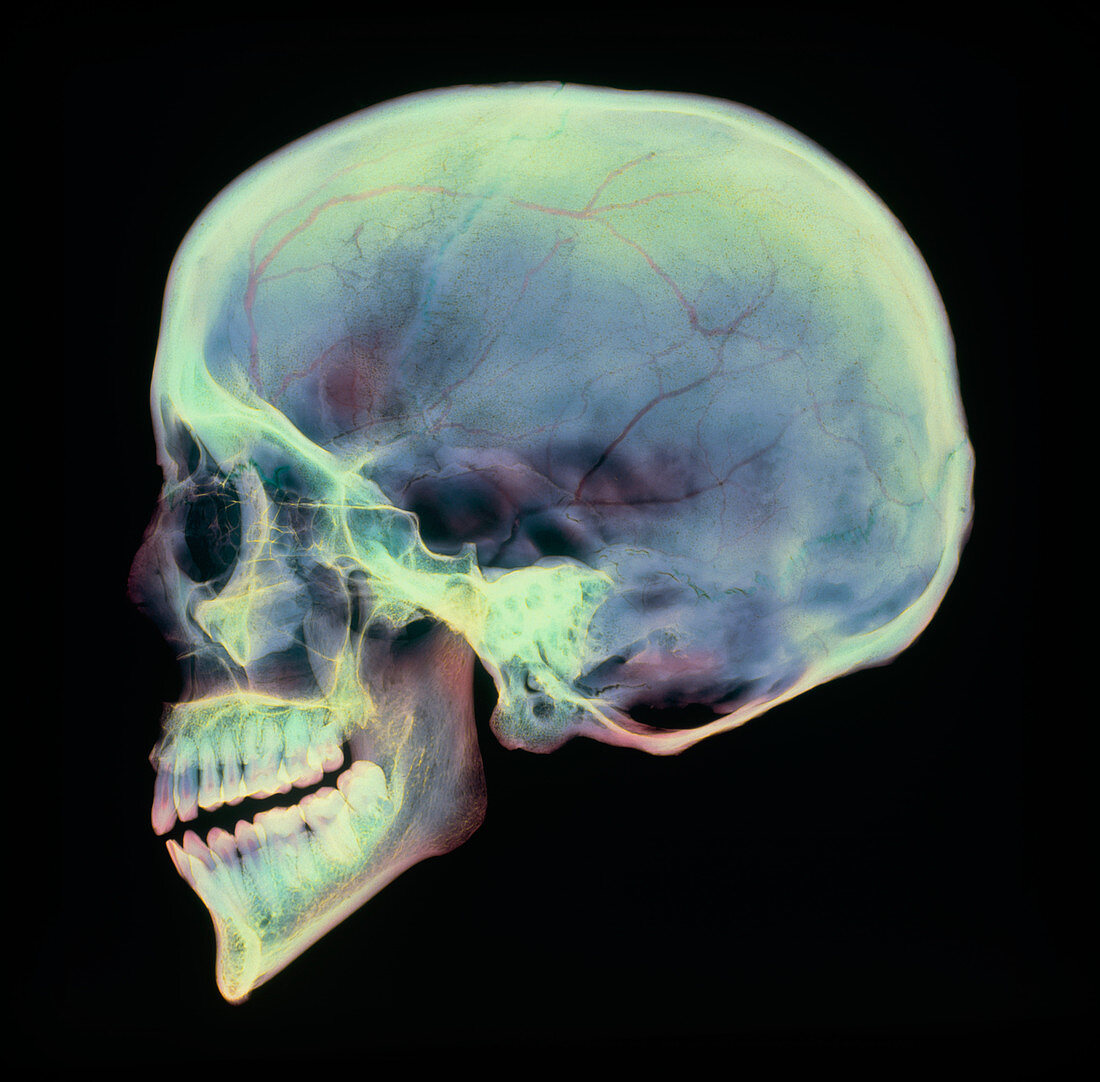 Human skull,X-ray
