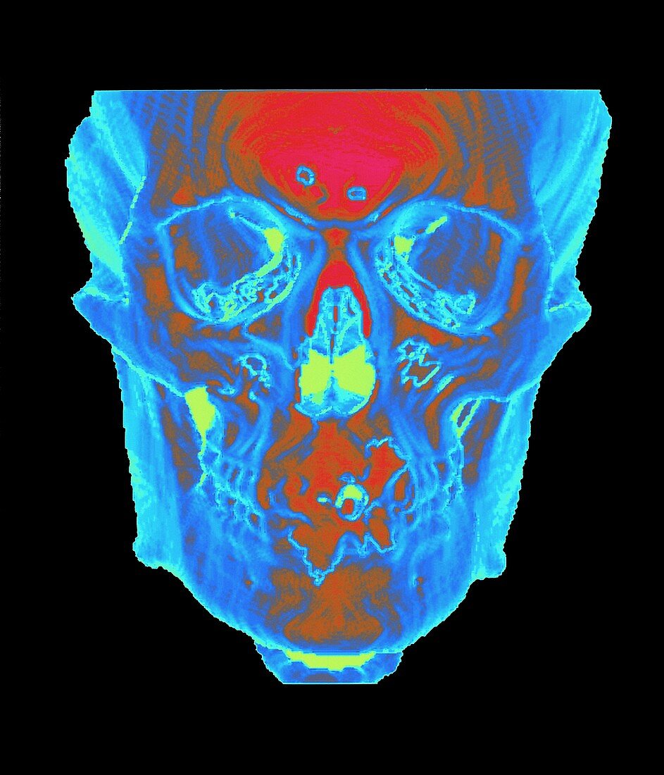 Skull,CT scan