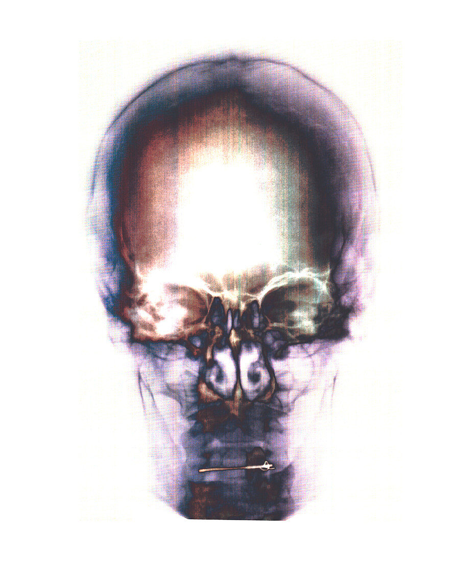 Human skull,X-ray