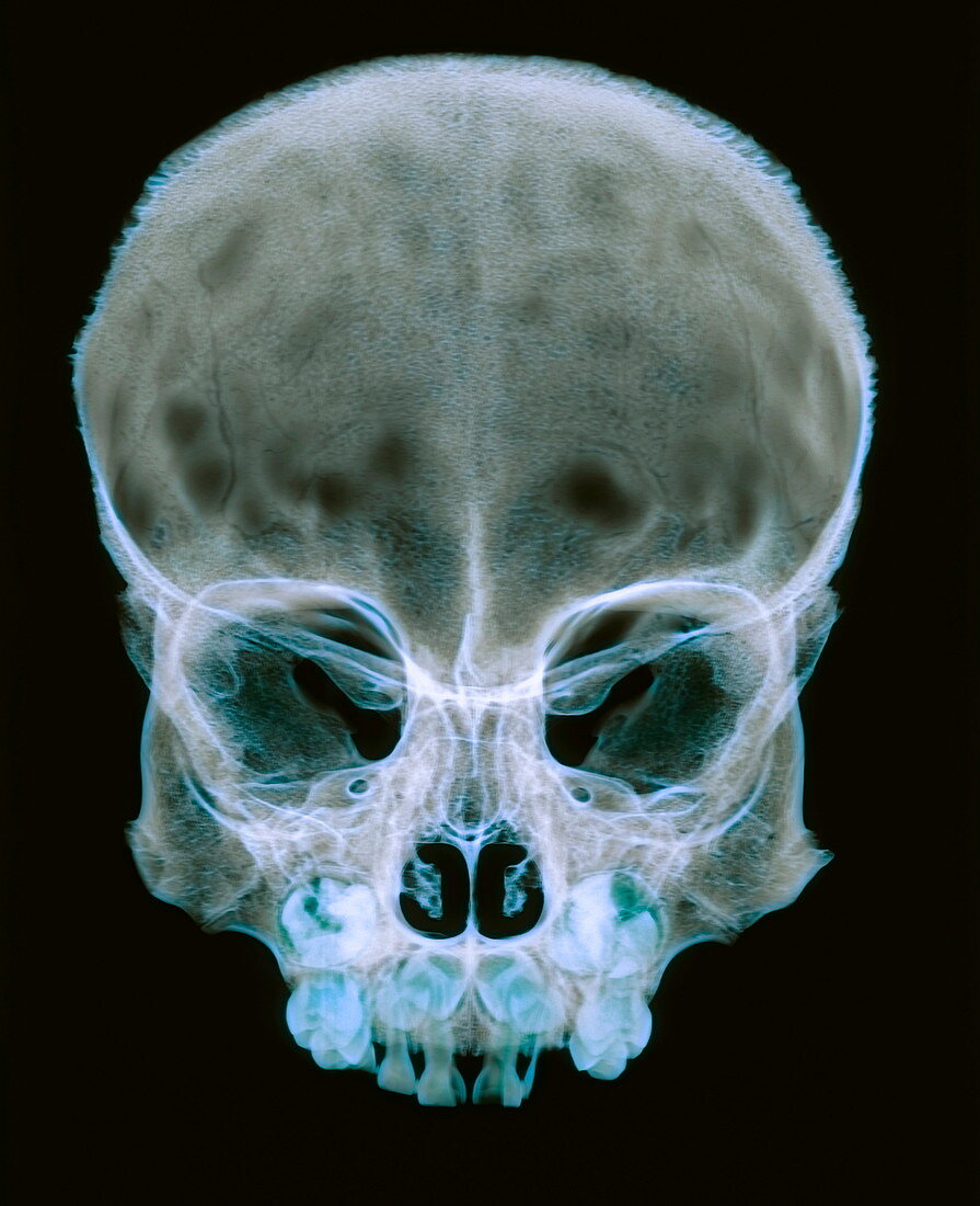 Child's skull