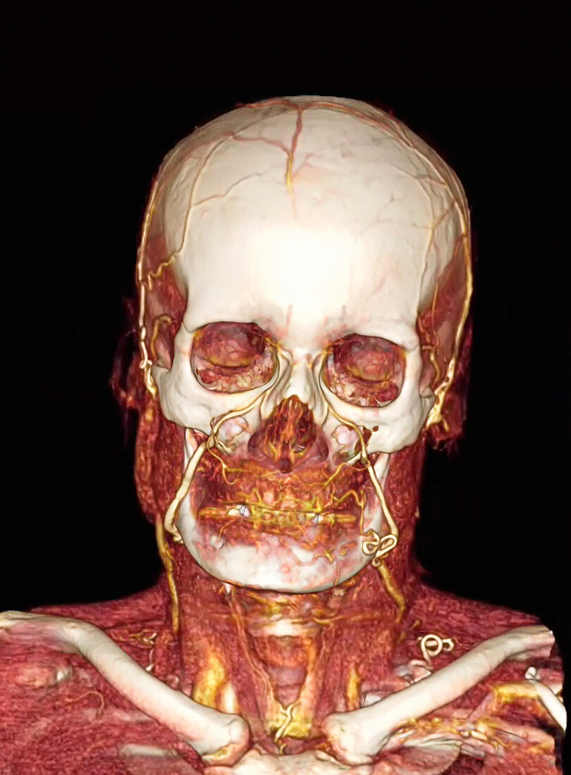 Head and neck,CT scan