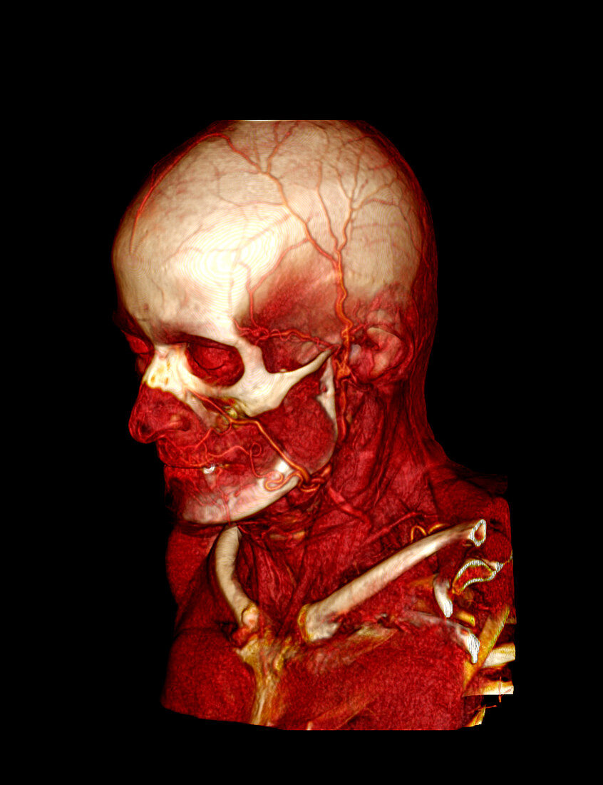 Human head and neck,CT scan
