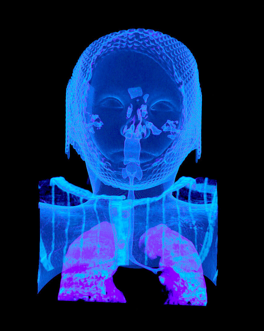 Child's head and chest,CT scan