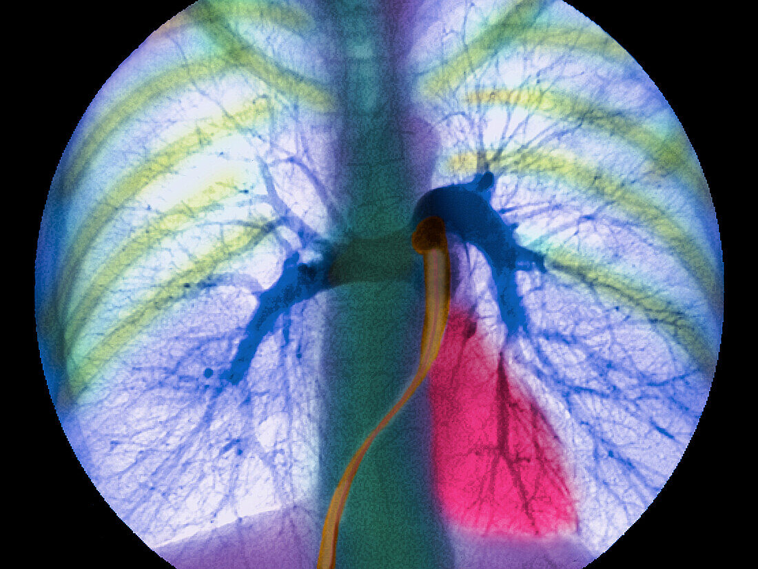 Coloured angiogram showing the pulmonary arteries